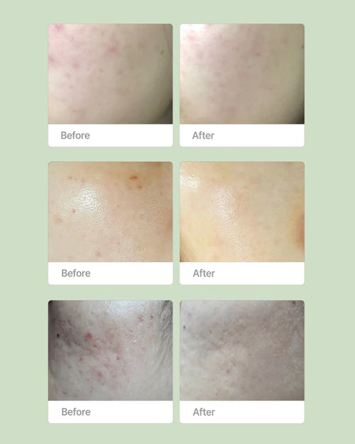 Acne + Oil Control Bundle